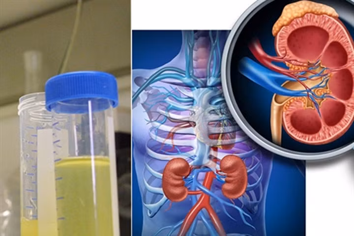 Đi tiểu mà có màu nước vo gạo, thận đã chuẩn bị sang "thời kì cuối"