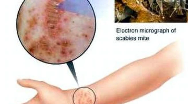 Ghẻ và thuốc điều trị