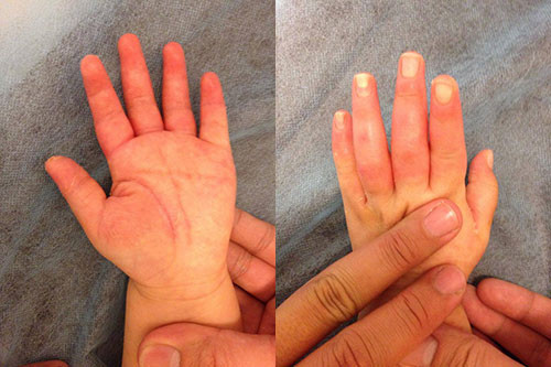 Cách xử lý khi trẻ bị bỏng mẹ nào cũng cần “nằm lòng“ ảnh 2 Cách xử lý khi trẻ bị bỏng mẹ nào cũng cần