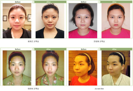 Xu hướng làm đẹp mới cho phụ nữ ngại đụng chạm dao kéo. - Ảnh 2 Xu huong lam dep moi cho phu nu ngai dung cham dao keo. - Anh 2