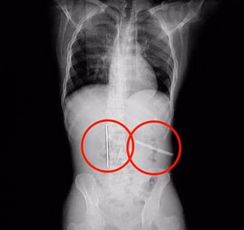 Hình chụp x-quang vật thể lạ bên trong dạ dày của Gong. Ảnh: Peoples Daily