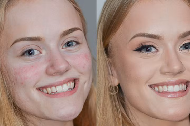 4 nguyên nhân hàng đầu làm bạn qua tuổi dậy thì mà vẫn mọc đầy mụn