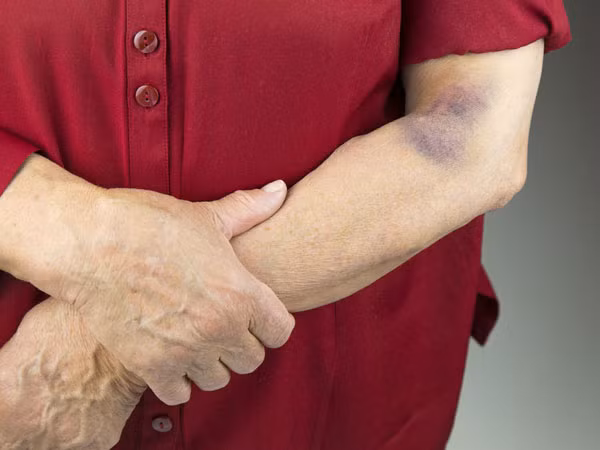 Vết bầm tím trên da cảnh báo những bệnh nguy hiểm nào?