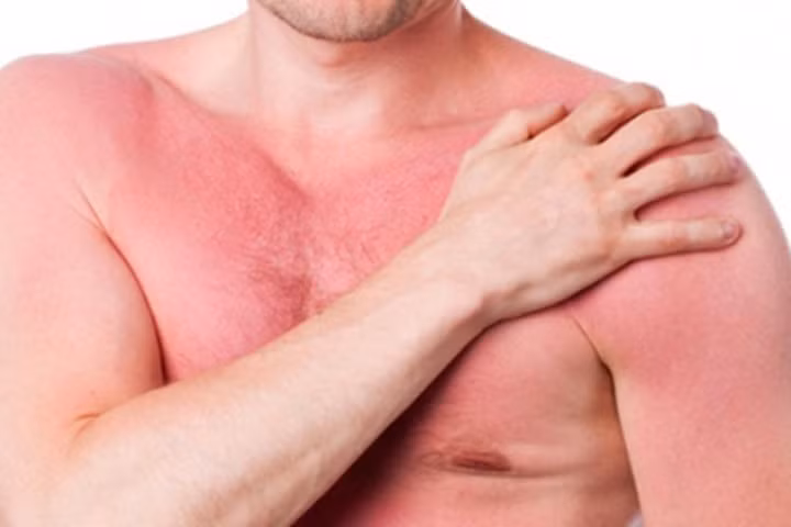 Triệt tiêu dị ứng ngay tại nhà - điều ai cũng cần biết