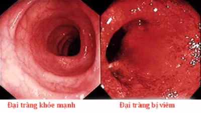 Viêm đại tràng dễ biến chứng thành giãn đại tràng cấp tính, thủng đại tràng, ung thư đại tràng…
