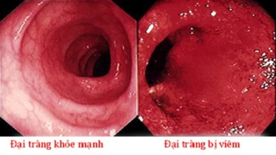 Viêm đại tràng dễ biến chứng thành giãn đại tràng cấp tính, thủng đại tràng, ung thư đại tràng…
