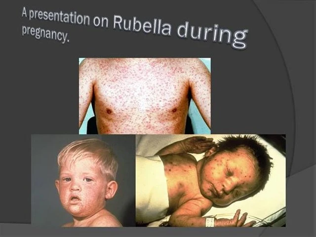 Rubella - Căn bệnh không thể xem nhẹ