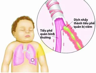 Hình ảnh viêm tiểu phế quản ở trẻ.