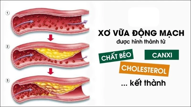 Ăn thêm choline có thể giúp giảm nguy cơ mắc bệnh tim mạch