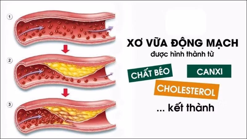 Ăn thêm choline có thể giúp giảm nguy cơ mắc bệnh tim mạch