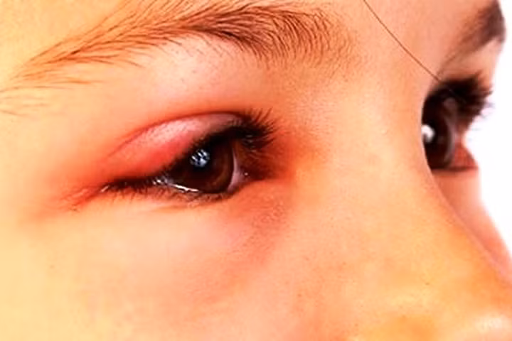 Lẹo mắt, làm sao để không tái phát?