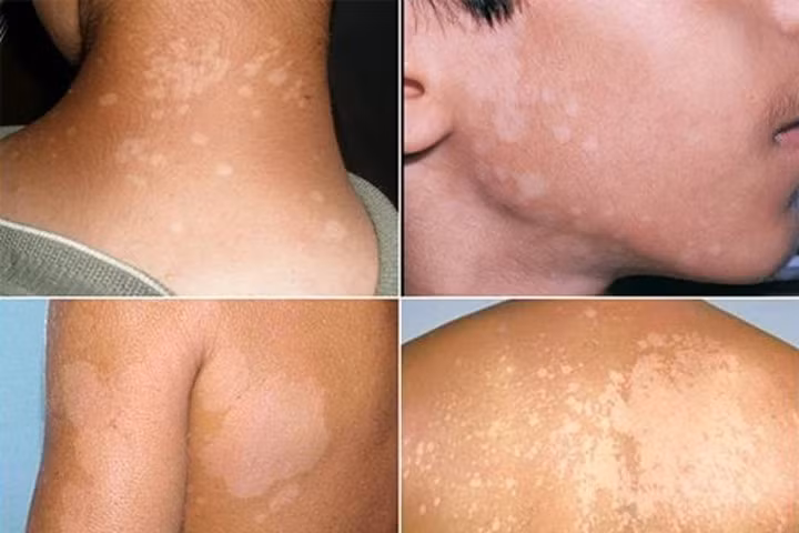 Bài thuốc dân gian đánh bay lang ben, cứ làm là khỏi