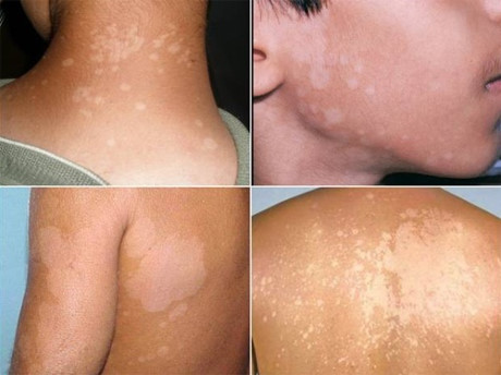 Bài thuốc dân gian đánh bay lang ben, cứ làm là khỏi - Ảnh 1 Bai thuoc dan gian danh bay lang ben, cu lam la khoi - Anh 1