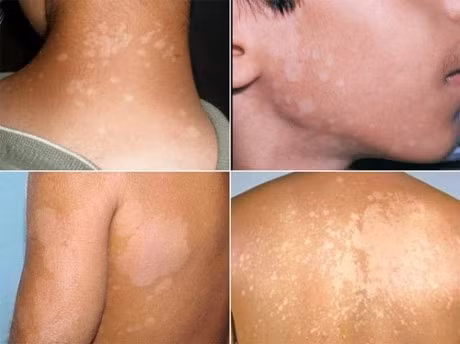 Bai thuoc dan gian danh bay lang ben, cu lam la khoi - Anh 1