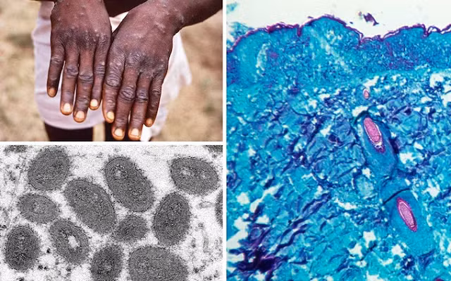 Bệnh đậu mùa khỉ.