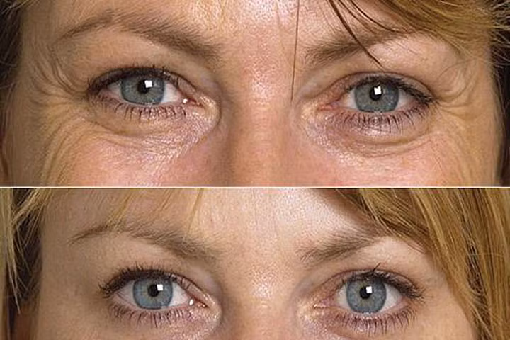 4 bí quyết xóa nếp nhăn vùng mắt dễ nhất
