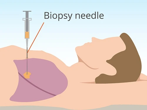 Sử dụng kim sinh thiết để tiến hành xét nghiệm ung thư phổi.