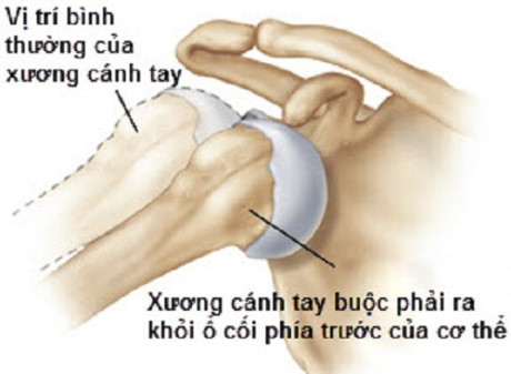 Trat khop vai hay tai phat, vi sao? - Anh 1