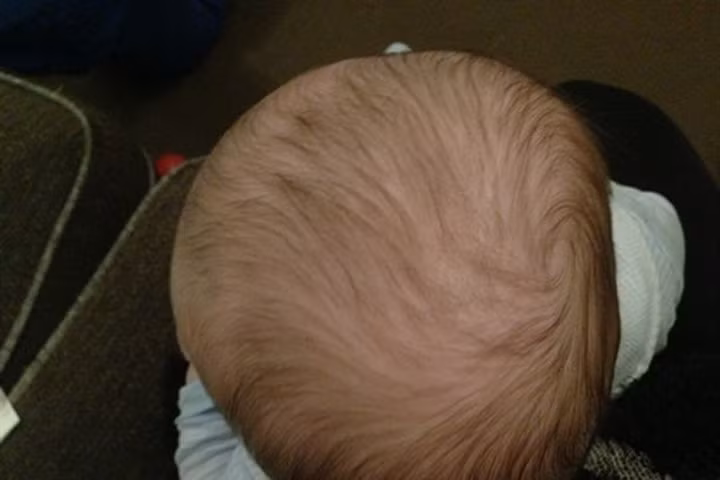 Mối nguy hại khi cho trẻ nhỏ nằm ngửa trong thời gian dài