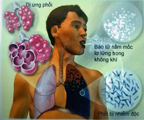 Benh nam phoi, dung chu quan - Anh 1