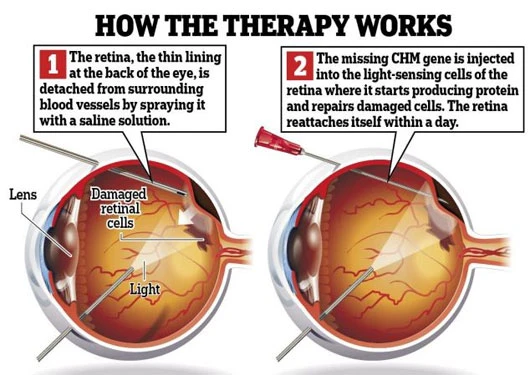 Hình mô phỏng cơ chế hoạt động của liệu pháp tiêm gene vào võng mạc để khôi phục thị lực cho bệnh nhân mắt. (Ảnh: Daily Mail)