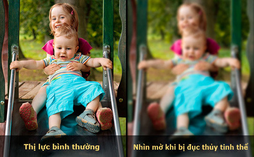 Nhìn mờ: Dấu hiệu bệnh lý mắt nguy hiểm