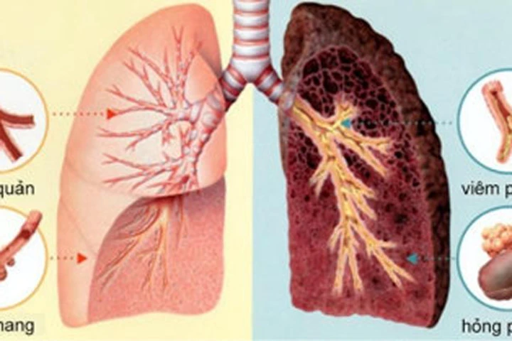 Chỉ mặt thủ phạm hàng đầu gây ung thư phổi ít ai ngờ