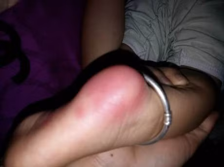 Tri ho bang cach lam nong gan ban chan nhu the nao cho chuan? - Anh 3