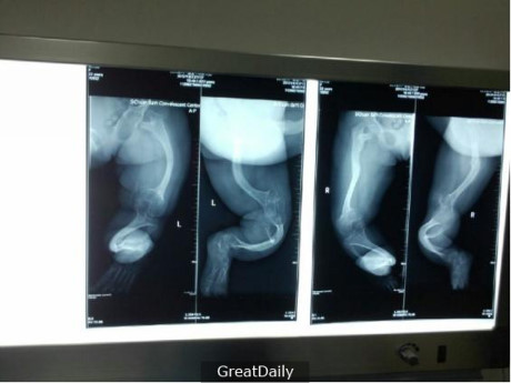 Mua giày rộng cho con đi để đỡ tốn tiền, mẹ chẳng thể ngờ chân con thành thế này - Ảnh 3 Mua giay rong cho con di de do ton tien, me chang the ngo chan con thanh the nay - Anh 3