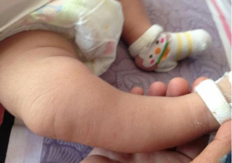 Mua giày rộng cho con đi để đỡ tốn tiền, mẹ chẳng thể ngờ chân con thành thế này - Ảnh 1 Mua giay rong cho con di de do ton tien, me chang the ngo chan con thanh the nay - Anh 1