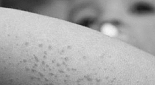 Dị ứng nổi mề đay: những điều cần tránh!