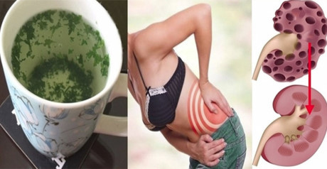 Thực hư chuyện rau mùi tây có thể đánh tan sỏi thận chỉ trong tích tắc - Ảnh 2 Thuc hu chuyen rau mui tay co the danh tan soi than chi trong tich tac - Anh 2