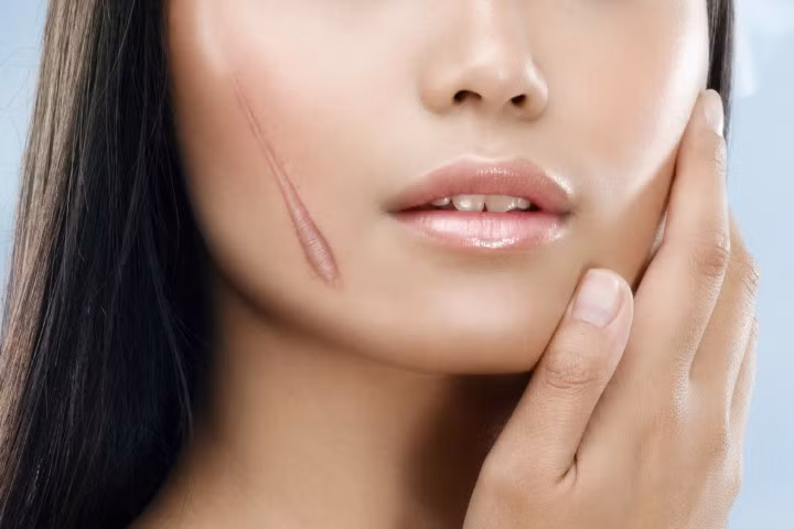 Trị sẹo thâm chưa đầy 10 phút bằng hỗn hợp đơn giản