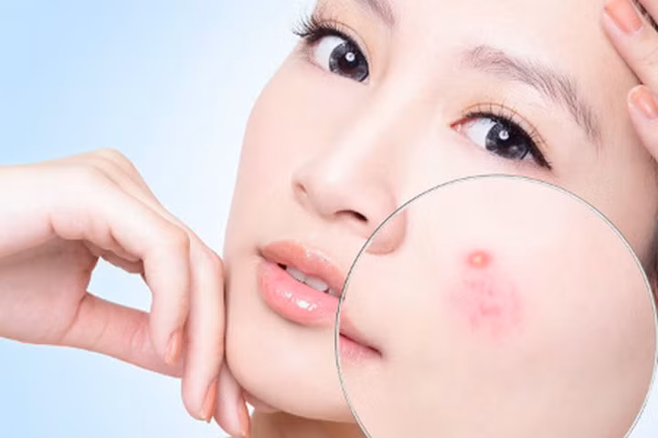 Cách trị mụn ẩn dưới da hiệu quả tại nhà