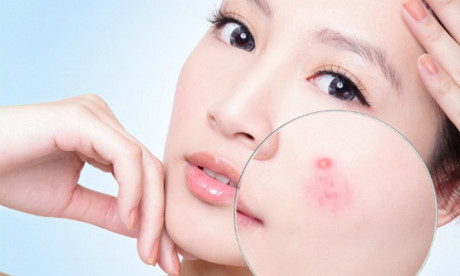 Cách trị mụn ẩn dưới da hiệu quả tại nhà - Ảnh 1 Cach tri mun an duoi da hieu qua tai nha - Anh 1