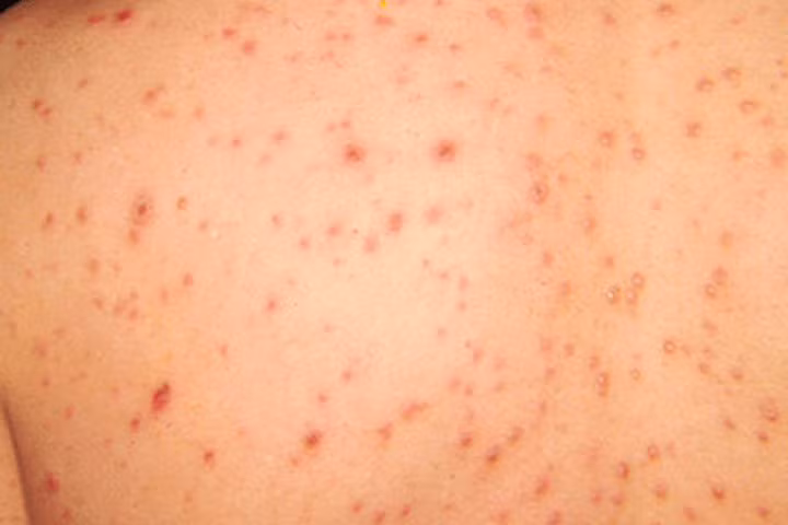 Bị thủy đậu: Điều gì xảy ra nếu kiêng gió, kiêng nước sai lầm?