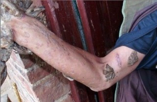 Phần tay chân phát bệnh bốc ra mùi hôi thối, khó chịu Mô tả ảnh.