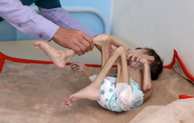 Cậu bé Faid Samim nặng 7kg vì nạn đói.