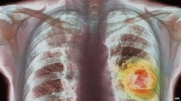 Nivolumab được là mang lại hy vọng thật sự cho bệnh nhân ung thư phổi