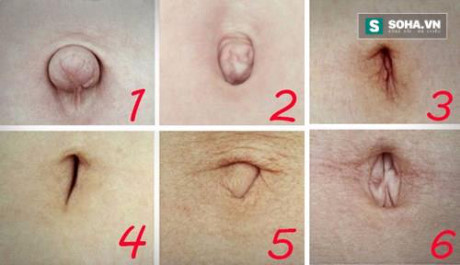 Nhìn hình dạng rốn để chẩn đoán sức khỏe - Ảnh 2 Nhin hinh dang ron de chan doan suc khoe - Anh 2