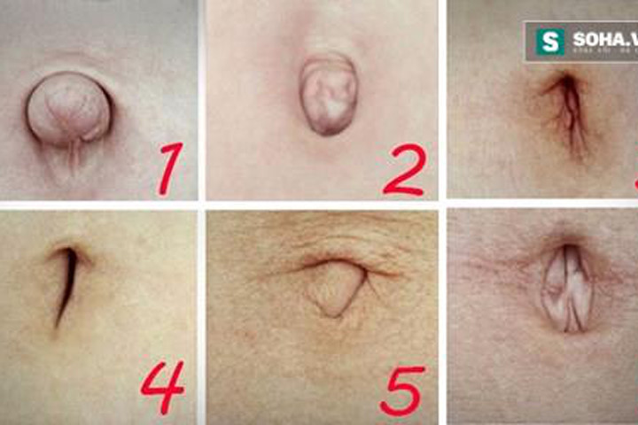 Nhìn hình dạng rốn để chẩn đoán sức khỏe
