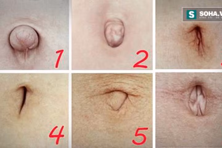 Nhìn hình dạng rốn để chẩn đoán sức khỏe