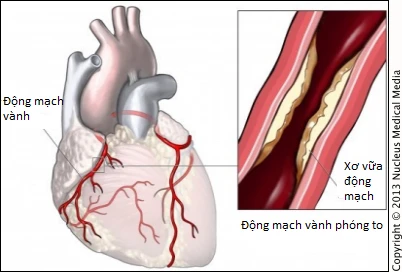 Cách phòng bệnh mạch vành