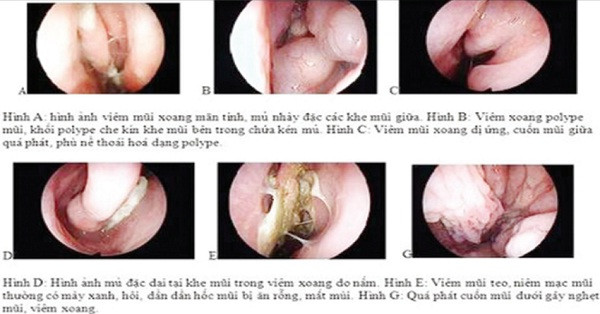 Viêm mũi cấp và mạn tính ảnh 1 Viêm mũi cấp và mạn tính