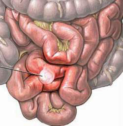 Dung chu quan voi chay mau tieu hoa - Anh 2