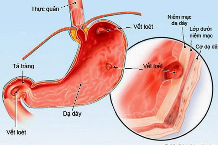 Phòng ngừa viêm dạ dày ở trẻ em