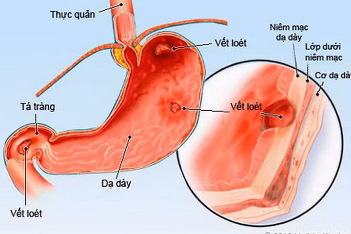 Phòng ngừa viêm dạ dày ở trẻ em