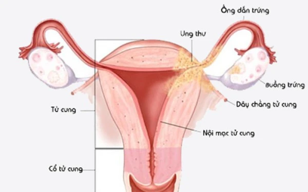 Lạc nội mạc tử cung là bệnh rất phổ biến ở phụ nữ trong độ tuổi sinh nở. Ảnh minh họa