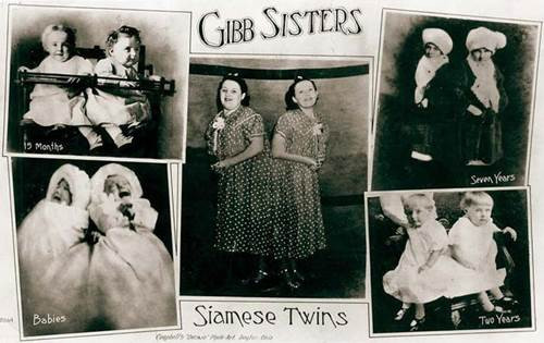 Chuyện tình yêu cảm động của cặp chị em sinh đôi dính liền ảnh 1 Chuyện tình yêu cảm động của cặp chị em sinh đôi dính liền - 1