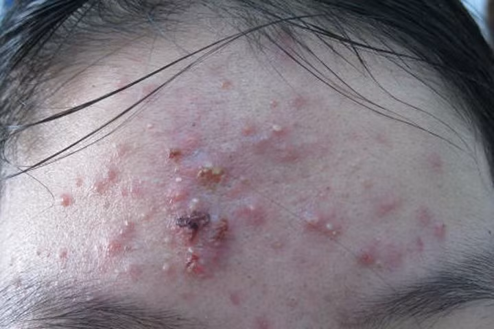 Mặt sần sùi, đỏ tấy vì "cấy phấn" làm đẹp